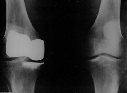 knee